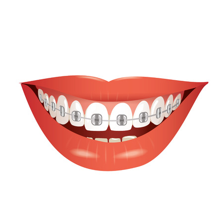 исправление зубов металлическими брекетами