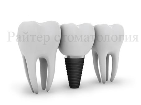 фото имплантов зубов
