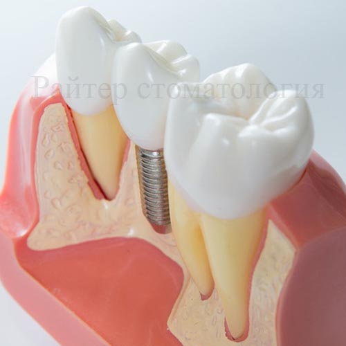 стоимость имплантации зубов