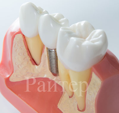 установить импланты на зубы